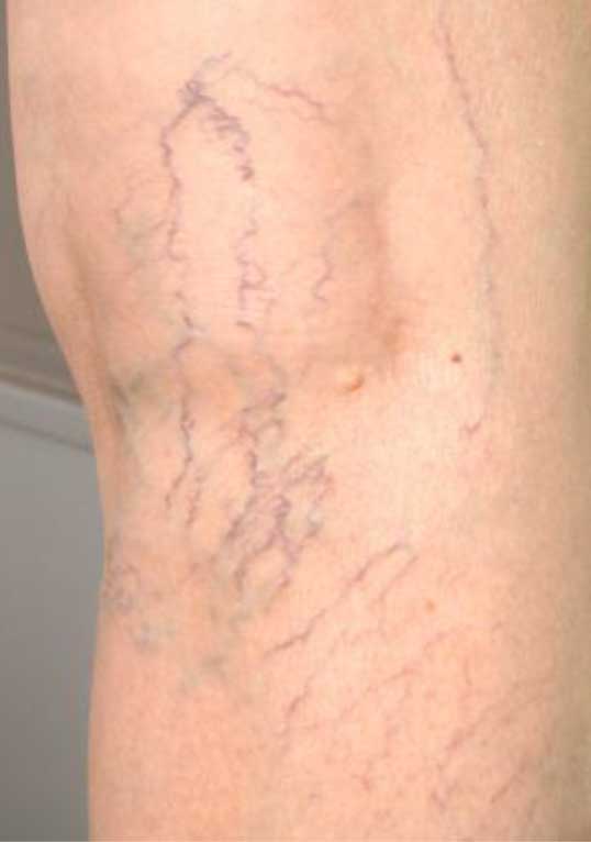 Sclerotherapy of spider veins