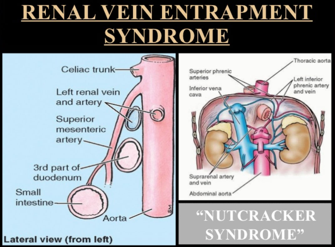Nutcracker Syndrome Vs Phenomenon At Alex Cruz Blog Nutcracker Syndrome Vs Phenomenon At Alex Cruz Blog
