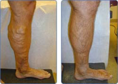 How Soon Will Veins Disappear After Sclerotherapy?