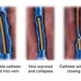 Varicose Veins - Vascular Care Centre