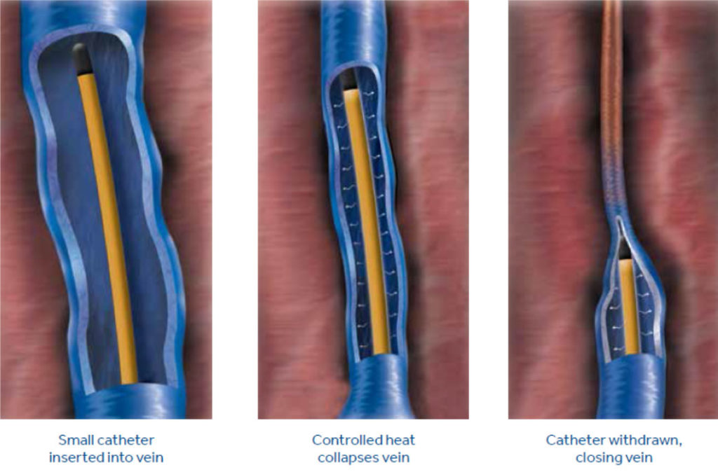 Thermal Ablation Of Varicose Veins - Vascular Care Centre